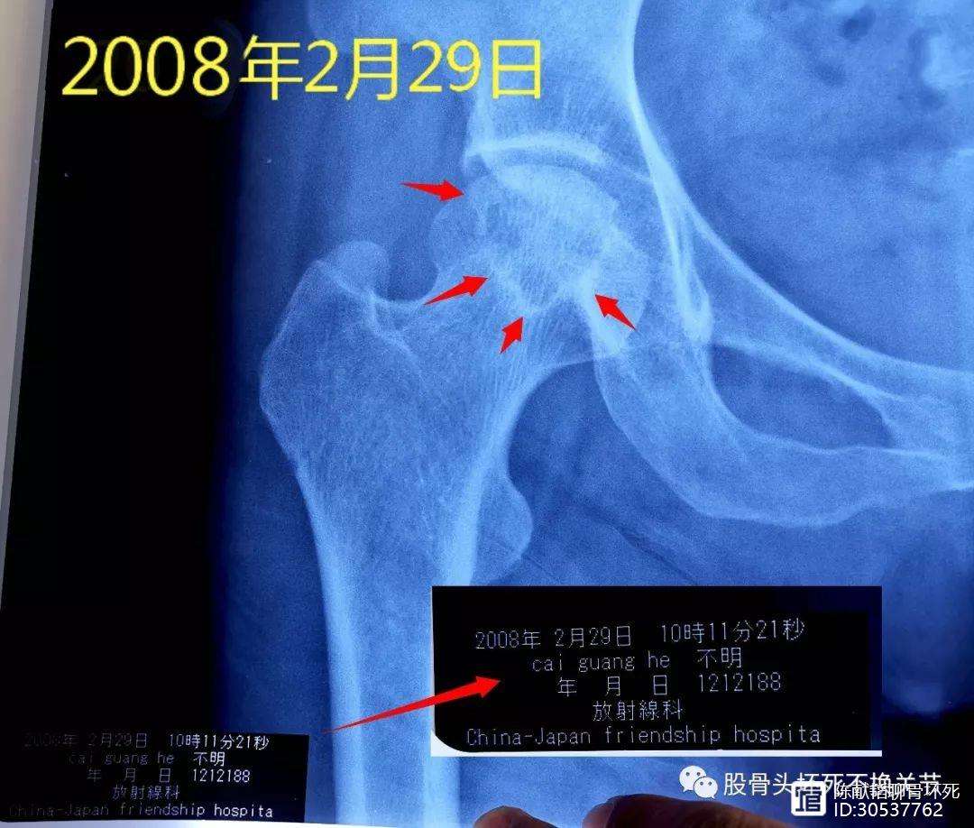 淮南人工骨头医保报销多少(人工骨头医保报销多少比例)